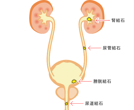 尿路結石と生活習慣による予防法 同友会メディカルニュース