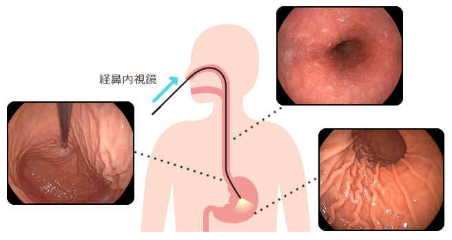 胃内視鏡検査のご案内