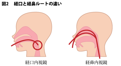 図2　経口と経鼻ルートの違い