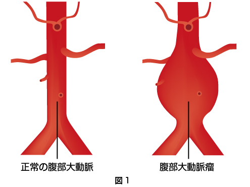 腹部大動脈瘤