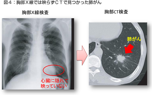 胸部Ｘ線では映らずＣＴで見つかった肺がん