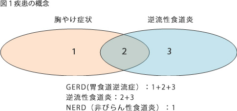 食道 炎 ストレス 逆流 性