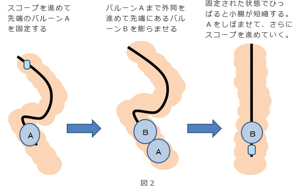 バルーン式小腸内視鏡2