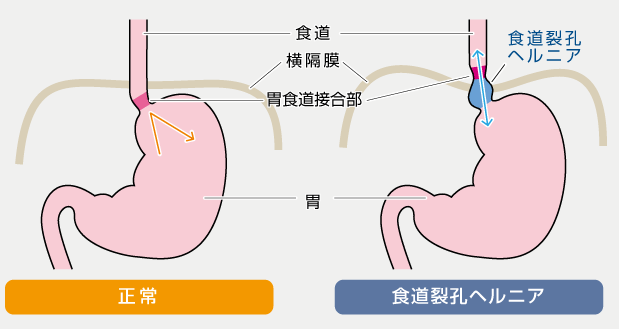 逆流 性 食道 炎 症状 背中 の 痛み