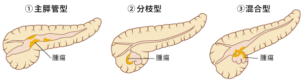 ＜IPMN分類＞（GL2012より改変）