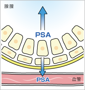 PSAは正常では腺腔にのみ分泌されるが、がんで正常組織が破壊されると血管にPSAが漏出し、血液中のPSA濃度が上昇