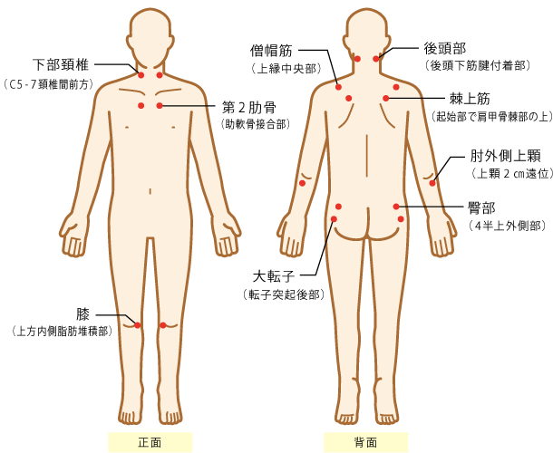 痛 完治 症 性 多発 筋 リウマチ