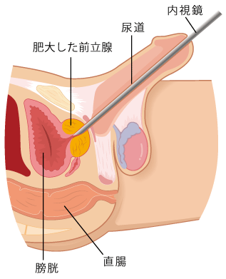 経尿道的前立腺切除術（TURP）