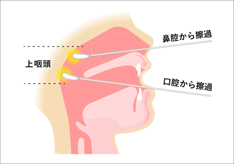 上咽頭擦過療法（EAT、Bスポット療法）