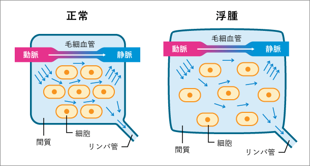 浮腫のイメージ
