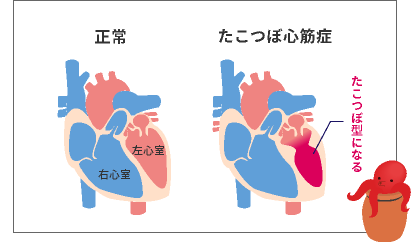 震災関連死とショック死